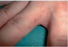 Abb. 2: Hautvernderungen mit Rtung, Schuppung und Einrissen im Fingerzwischenraum