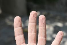Abb. 3: Durch Feuchtigkeit faltig aufgequollene Haut an den Fingern (Waschfrauenhnde)